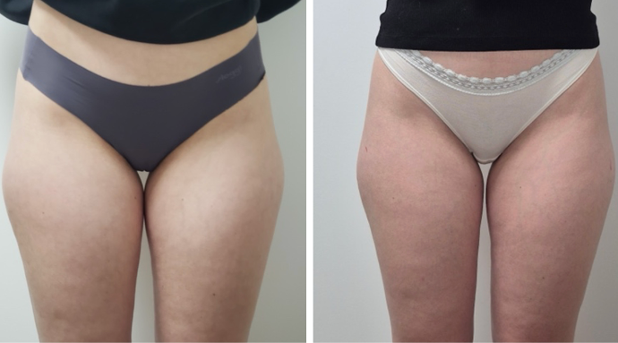 cryolipolyse_cuisses_avant_apres